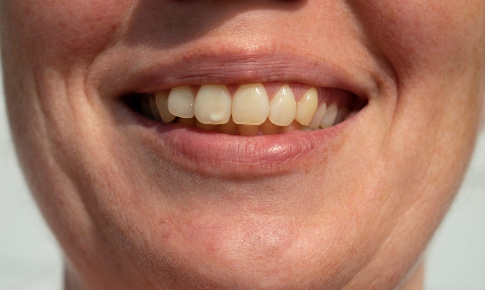 7 Surprising Vitamins That Can Stain Teeth or Cause Dry and Dark Lips – One Green Planet - Vimarsana News